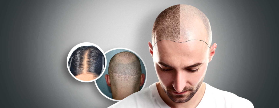 scalp micropigmentation treatment